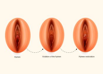 Hymenoplasty Surgery: A Comprehensive Overview